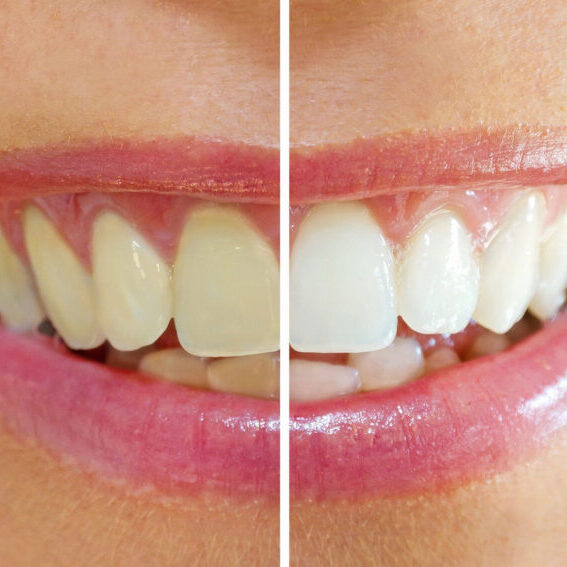 before and after teeth whitening